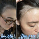 best vitamins for hair loss postpartum