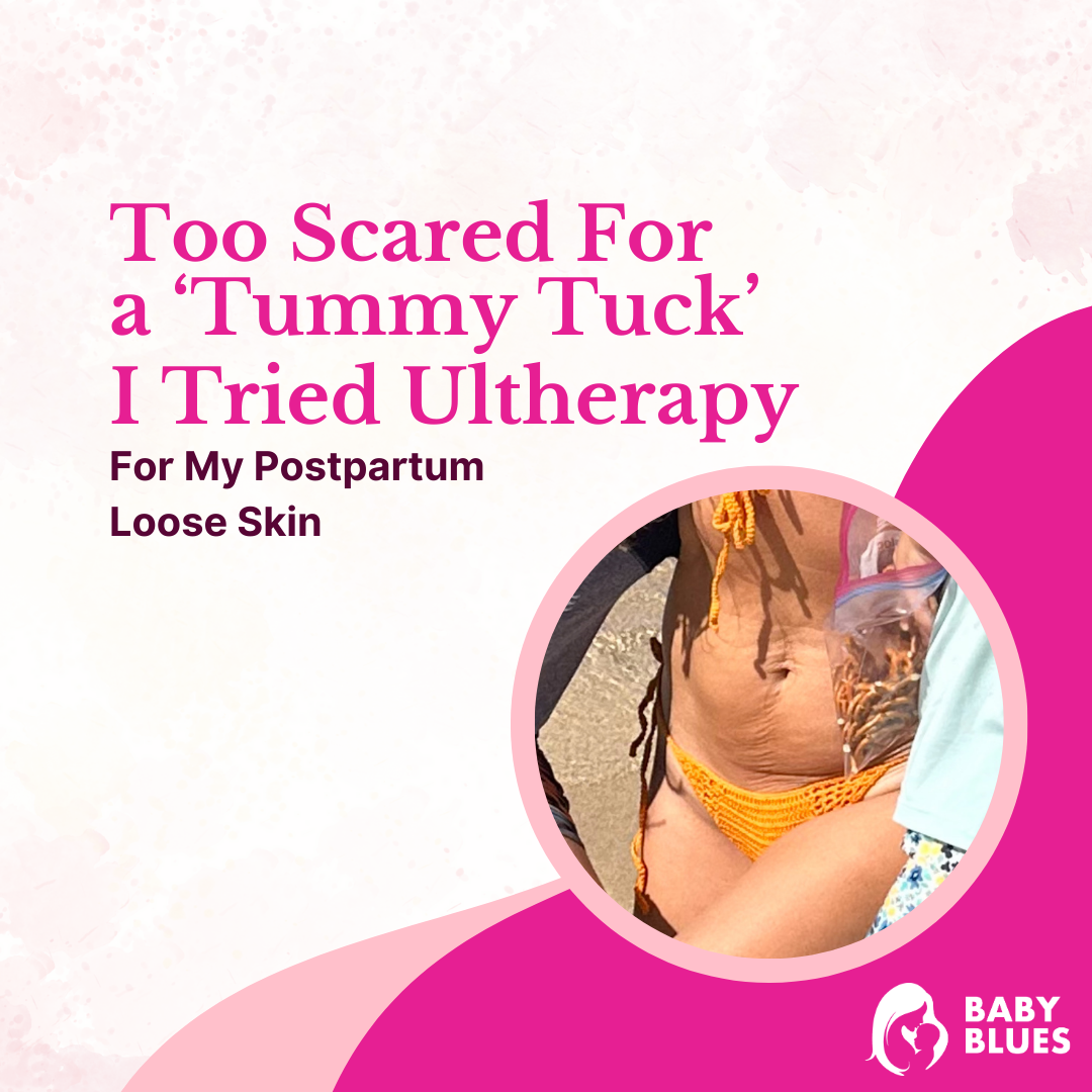 Too Scared For A Tummy Tuck, I Tried Ultherapy For My Postpartum Loose Skin