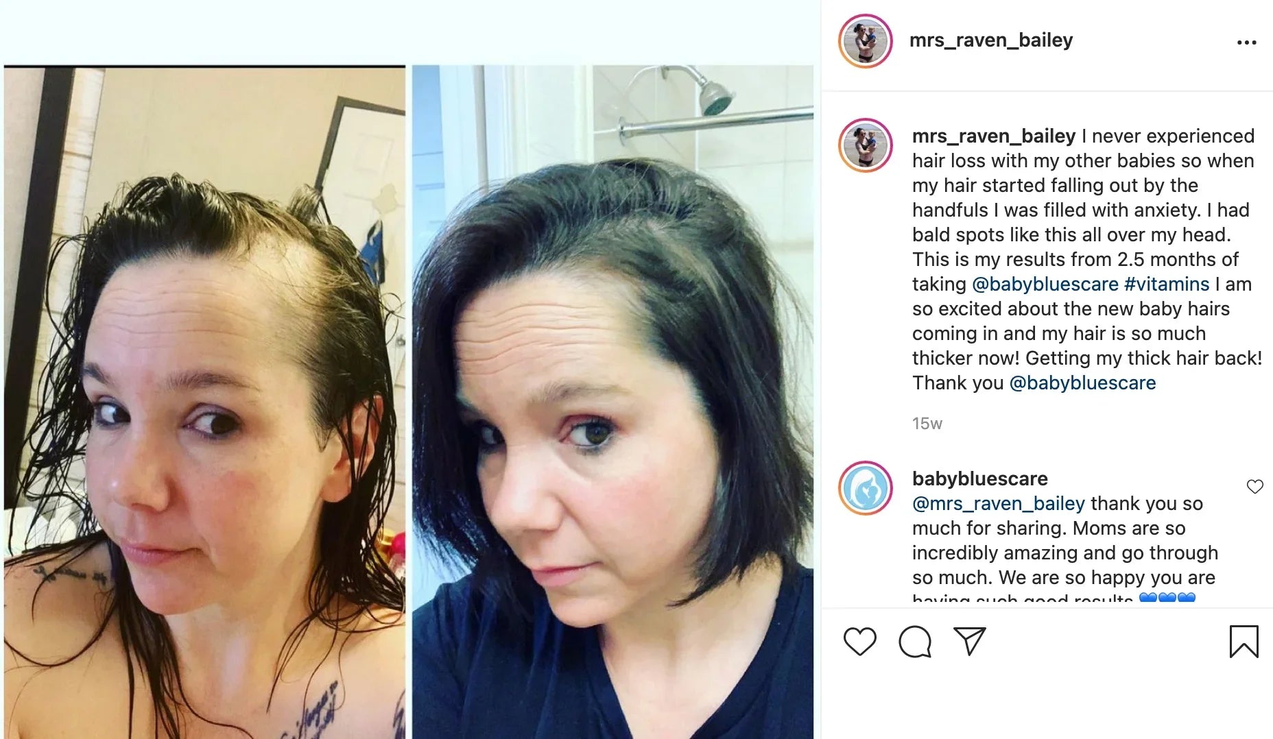 Postpartum hair loss journey