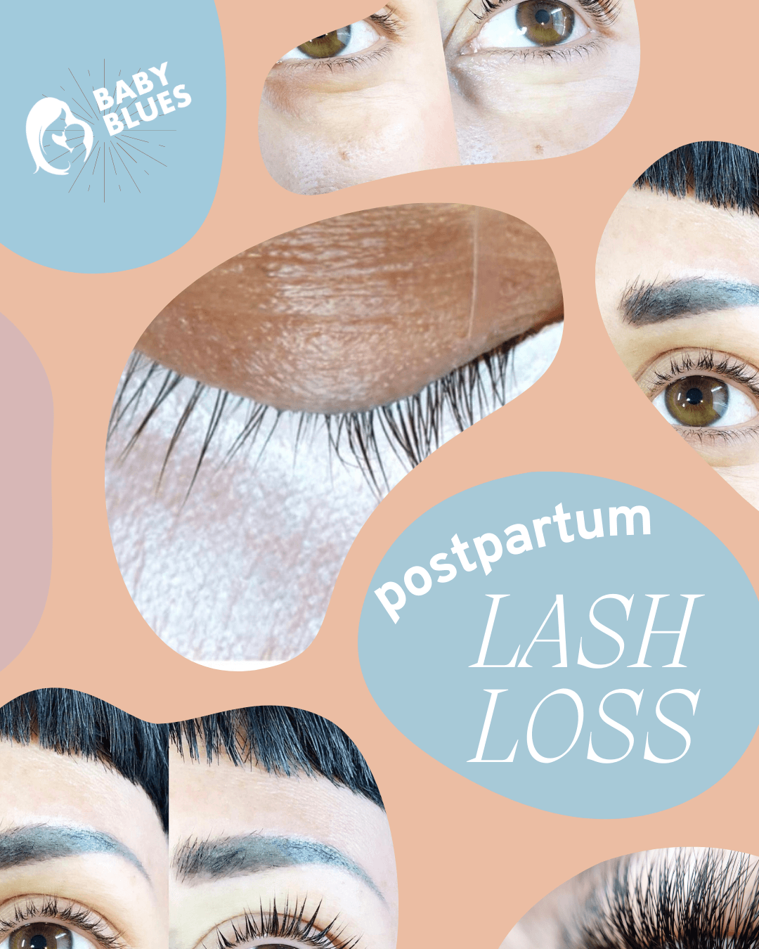 Postpartum lash loss