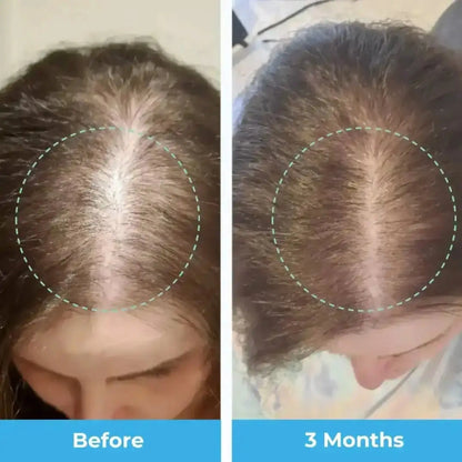 Postpartum Hair Loss Vitamins Baby-Blues