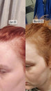 best hair vitamins for postpartum hair loss