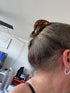 hair loss postpartum vitamins