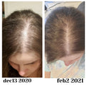 Hair Shedding After Pregnancy