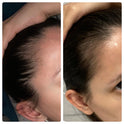 hair vitamins for postpartum hair loss