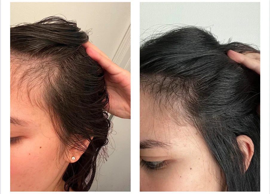 postpartum vitamins hair loss
