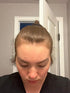 vitamins to help postpartum hair loss